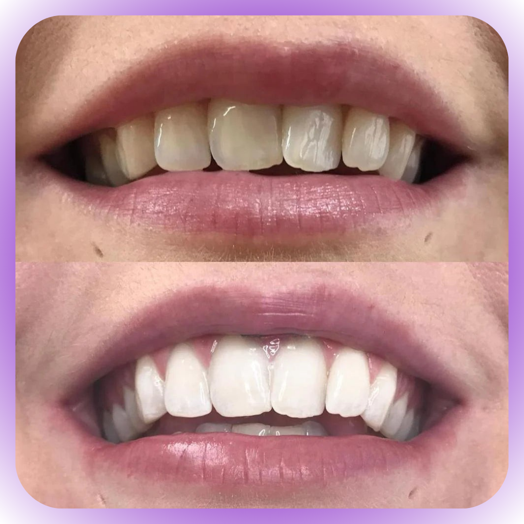 Smile - Blanqueador Dental V34