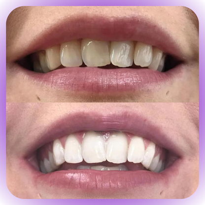 Smile - Blanqueador Dental V34